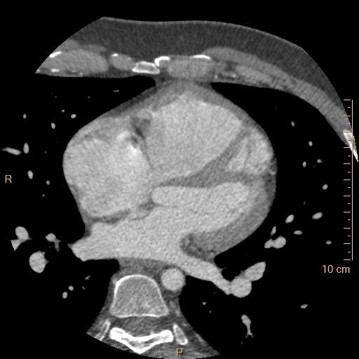 Atrial septal defect (upper sinus venosus type) with partial anomalous pulmonary venous return into superior vena cava (Radiopaedia 73228-83961 A 138).jpg