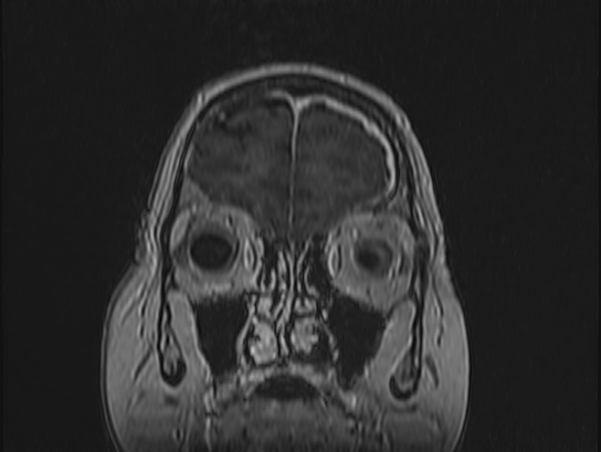 Atypical meningioma (Radiopaedia 62985-71406 Coronal T1 C+ 13).jpg