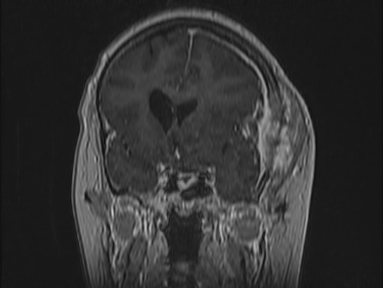 Atypical meningioma (Radiopaedia 62985-71406 Coronal T1 C+ 39).jpg