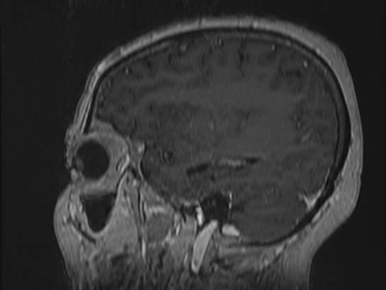 Atypical meningioma (Radiopaedia 62985-71406 Sagittal T1 C+ 19).jpg