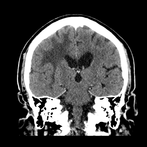 Atypical meningioma (WHO grade II) with brain invasion (Radiopaedia 57767-64728 Coronal C+ 36).png