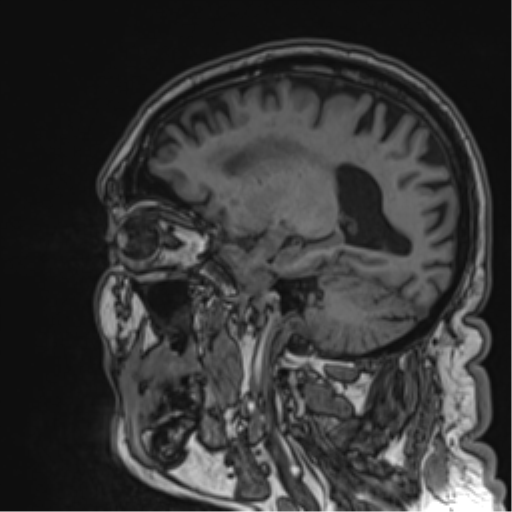 Atypical meningioma (WHO grade II) with brain invasion (Radiopaedia 57767-64729 Sagittal T1 27).png