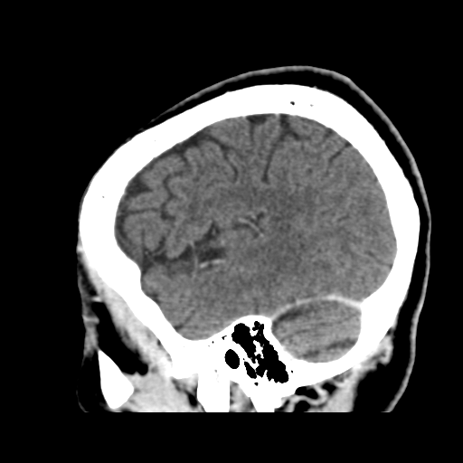 Atypical meningioma (WHO grade II) with osseous invasion (Radiopaedia 53654-59715 G 43).png