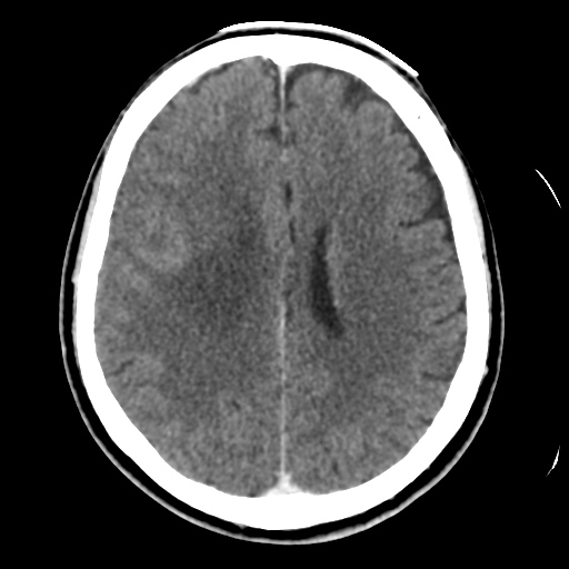 Atypical meningioma with skull invasion (Radiopaedia 34357-35649 Axial C+ delayed 34).png