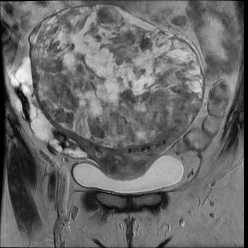File:Atypical retroperitoneal lymphocoeles with large leiomyoma of uterus (Radiopaedia 32084-33027 Coronal T2 11).jpg