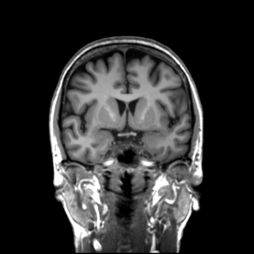 Autoimmune limbic encephalitis (Radiopaedia 30363-31005 Coronal T1 35).jpg