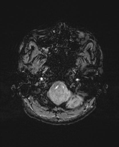 Autoimmune limbic encephalitis (Radiopaedia 30363-31005 SWI 9).jpg