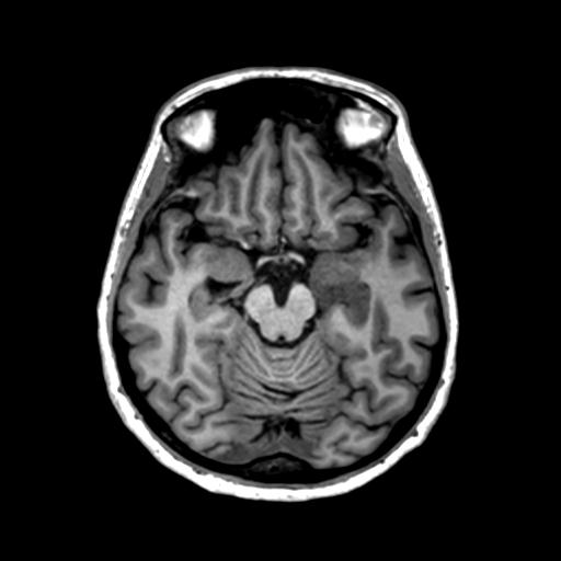 Autoimmune limbic encephalitis (Radiopaedia 30363-31005 T1 Axial 1mm 61).jpg