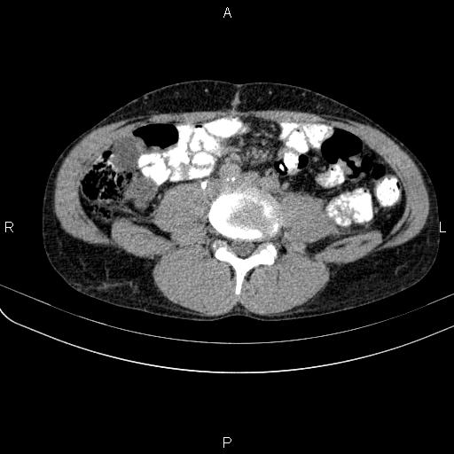 Autoimmune pancreatitis (Radiopaedia 84925-100431 Axial C+ delayed 53).jpg