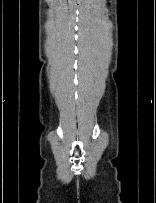 Autoimmune pancreatitis (Radiopaedia 84925-100431 D 60).jpg