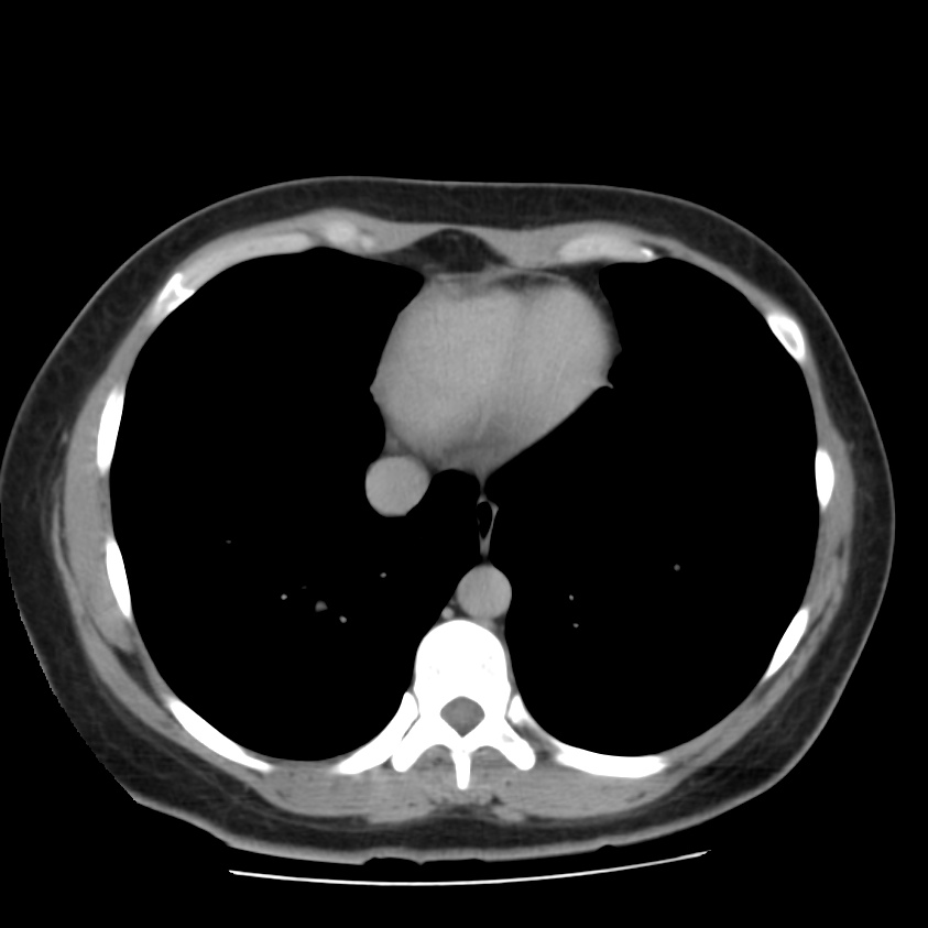 Autosomal dominant polycystic kidney disease (Radiopaedia 23061-23093 C+ delayed 3).jpg