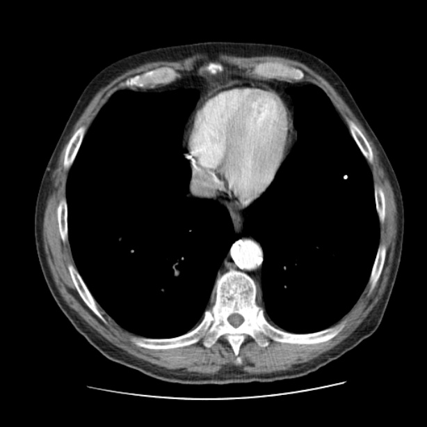 Autosomal dominant polycystic kidney disease (Radiopaedia 27851-28094 B 44).jpg