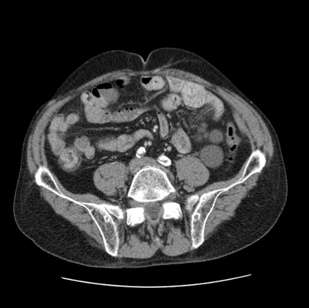 Autosomal dominant polycystic kidney disease (Radiopaedia 27851-28094 B 90).jpg