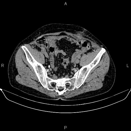 Autosomal dominant polycystic kidney disease (Radiopaedia 87830-104287 Axial non-contrast 46).jpg