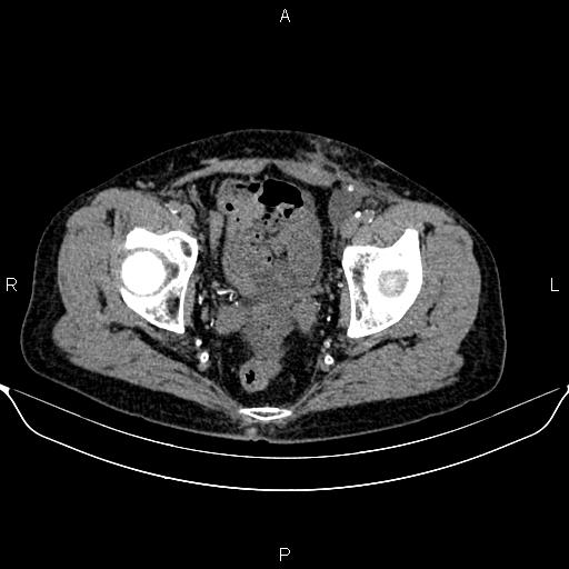 Autosomal dominant polycystic kidney disease (Radiopaedia 87830-104287 Axial non-contrast 51).jpg