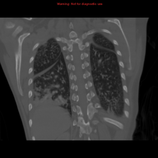 File:Avascular necrosis in sickle cell disease (Radiopaedia 17448-17152 Coronal bone window 100).jpg
