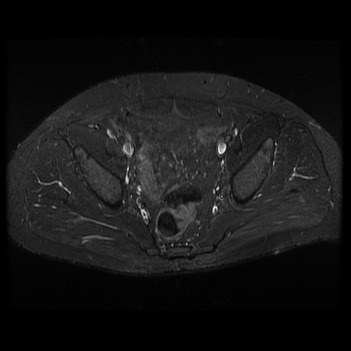 File:Avascular necrosis of the hip (Radiopaedia 61503-69465 Axial STIR 10).jpg