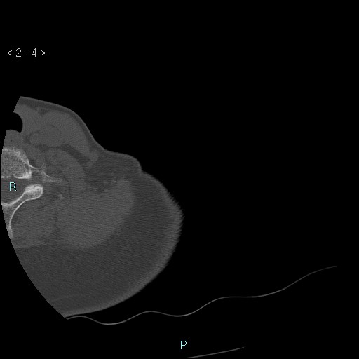 File:Avascular necrosis of the shoulder - Cruess stage I (Radiopaedia 77674-89887 Axial bone window 1).jpg