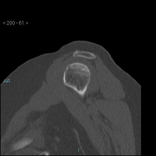 Avascular necrosis of the shoulder - Cruess stage I (Radiopaedia 77674-89887 Sagittal bone window 60).jpg