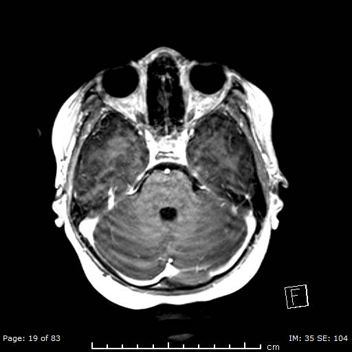 Balo concentric sclerosis (Radiopaedia 61637-69636 Axial T1 C+ 19).jpg