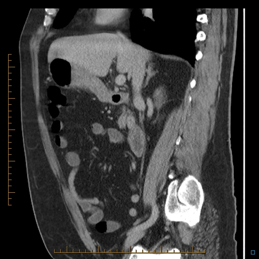 File:Bariatric balloon causing gastric outlet obstruction (Radiopaedia 54449-60672 C 50).jpg