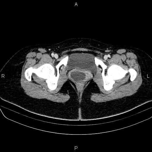 File:Bartholin gland cyst (Radiopaedia 62635-70930 Axial Post contrast 74).jpg