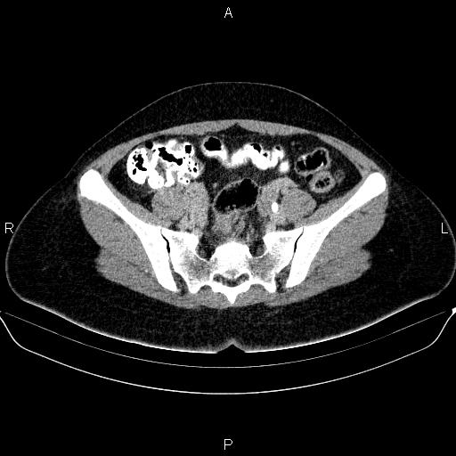 Bartholin gland cyst (Radiopaedia 62635-70930 C 27).jpg