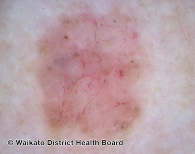 File:Basal cell carcinoma affecting the arms and legs 1 dermoscopy (DermNet NZ bcc-1a-derm).jpg