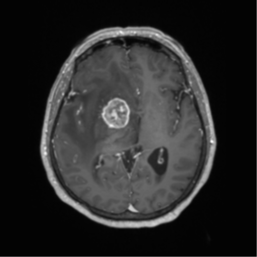 Basal ganglia metastasis (Radiopaedia 78928-91828 Axial T1 C+ 35).png
