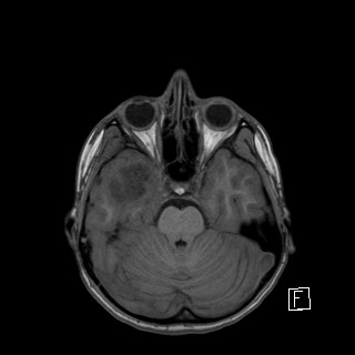 Base of skull rhabdomyosarcoma (Radiopaedia 32196-33142 Axial T1 16).jpg