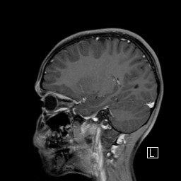 Base of skull rhabdomyosarcoma (Radiopaedia 32196-33142 J 41).jpg