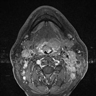 File:Base of tongue squamous cell carcinoma (Radiopaedia 31174-31884 Axial T1 C+ fat sat 16).jpg