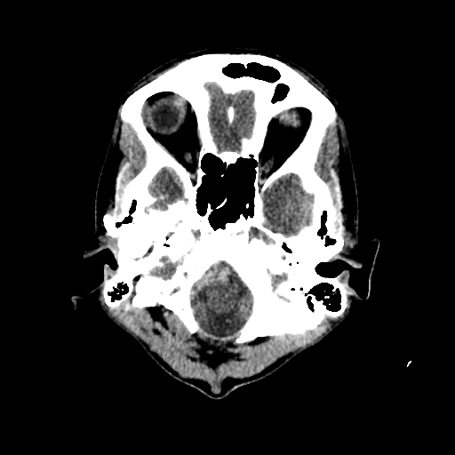 File:Basilar artery perforator aneurysm (Radiopaedia 82455-96597 Axial non-contrast 3).jpg