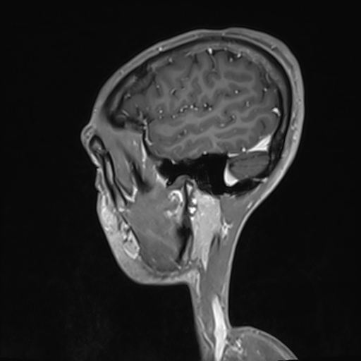Basilar artery perforator aneurysm (Radiopaedia 82455-97733 G 124).jpg