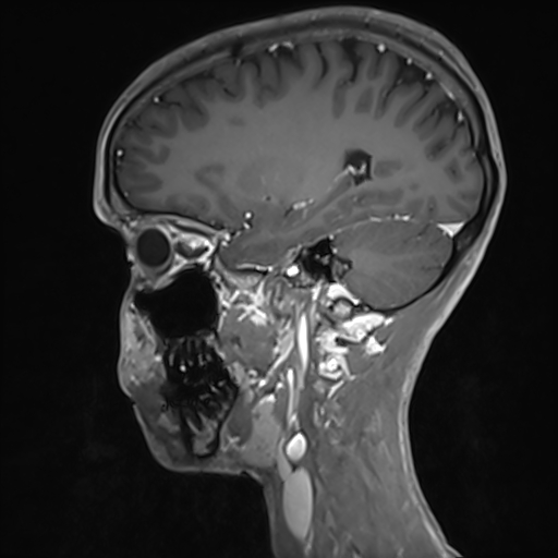 Basilar artery perforator aneurysm (Radiopaedia 82455-97733 G 51).jpg