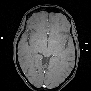 Basilar artery perforator aneurysm (Radiopaedia 82455-99523 F 71).jpg