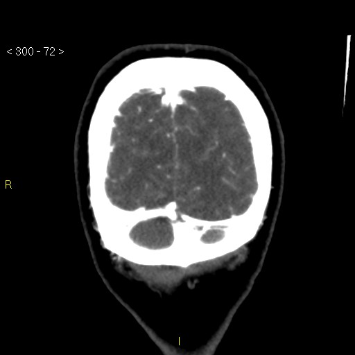 Basilar artery thrombosis (Radiopaedia 16260-15944 B 63).jpg