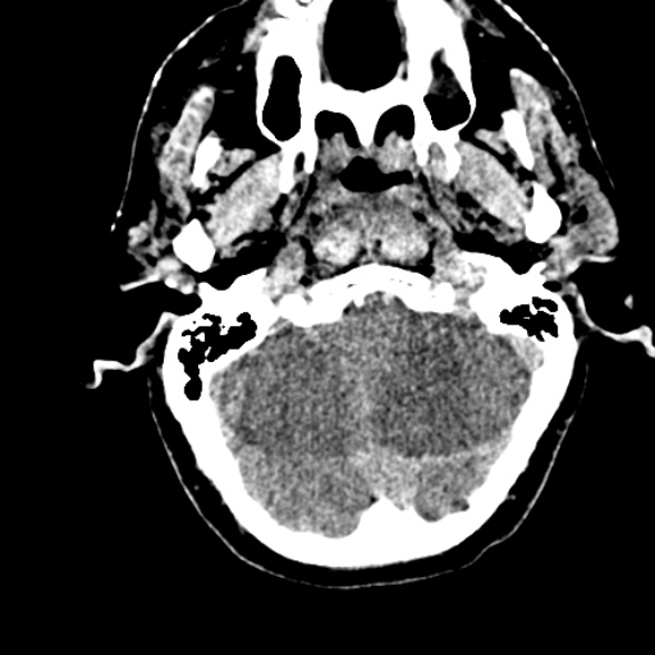 Basilar artery thrombosis (Radiopaedia 53351-59352 Axial non-contrast 28).jpg