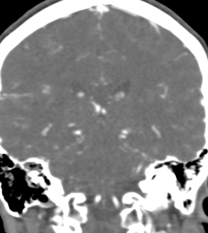 File:Basilar tip aneurysm with coiling (Radiopaedia 53912-60086 B 94).jpg