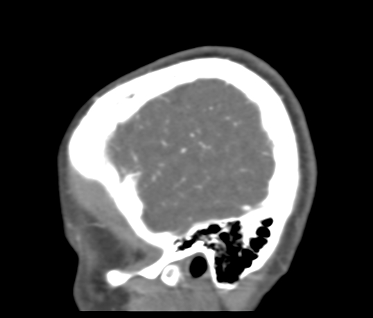 Basilar tip aneurysm with coiling (Radiopaedia 53912-60086 C 122).jpg