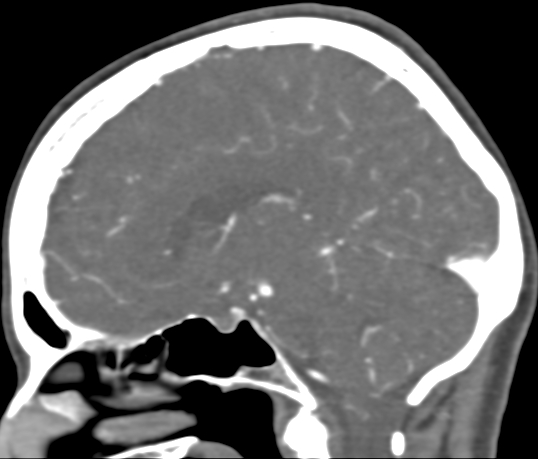 Basilar tip aneurysm with coiling (Radiopaedia 53912-60086 C 59).jpg