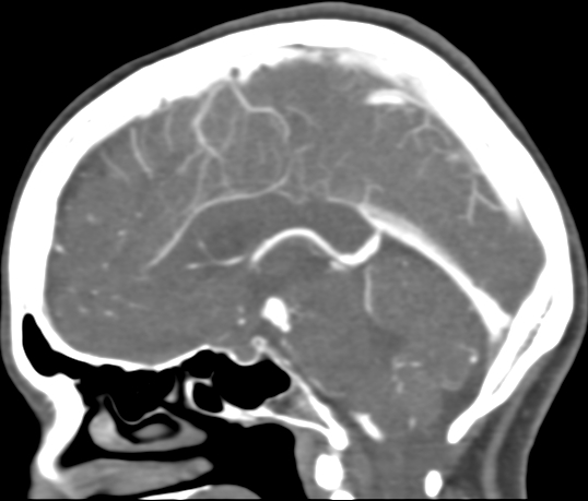 Basilar tip aneurysm with coiling (Radiopaedia 53912-60086 C 69).jpg