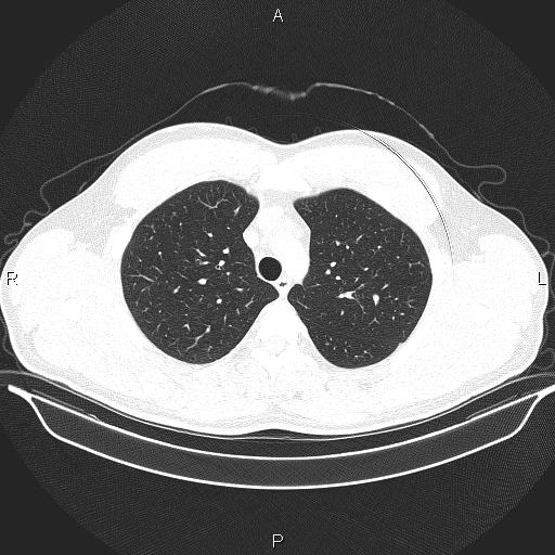 Beam hardening and ring artifacts (Radiopaedia 85323-100915 Axial lung window 23).jpg