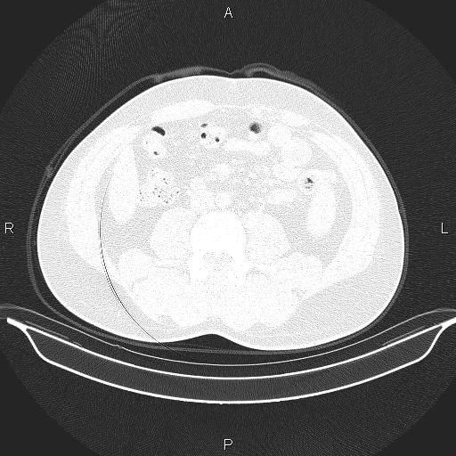 File:Beam hardening and ring artifacts (Radiopaedia 85323-100915 Axial lung window 97).jpg