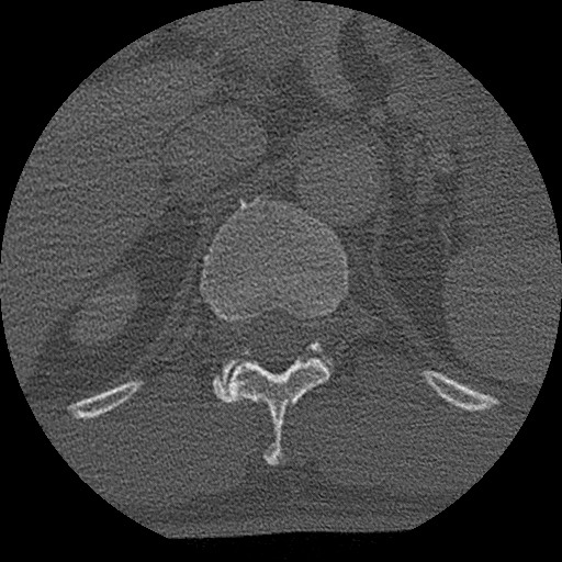 Benign post-traumatic pseudopneumoperitoneum (Radiopaedia 71199-81495 Axial bone window 169).jpg