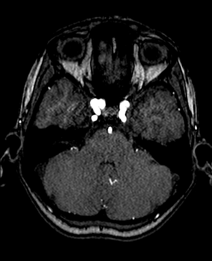 Berry aneurysm of the terminal internal carotid artery (Radiopaedia 88286-104918 Axial TOF 81).jpg