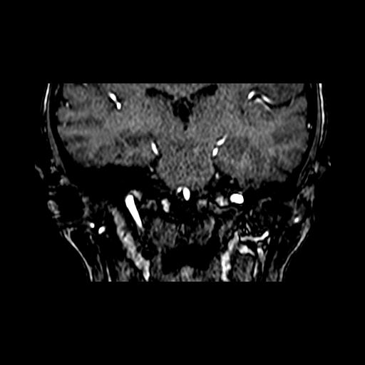 Berry aneurysm of the terminal internal carotid artery (Radiopaedia 88286-104918 Coronal TOF 58).jpg