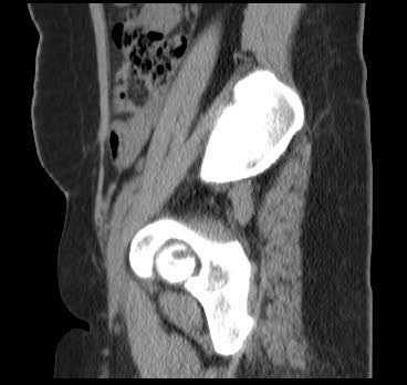 File:Bicornuate uterus (MRI) (Radiopaedia 49206-54296 Sagittal 17).png