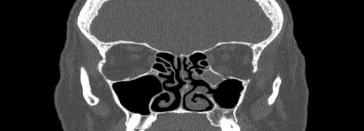 Bilateral Ectopic Infraorbital Nerves (Radiopaedia 49006-54084 Coronal bone window 36).jpg