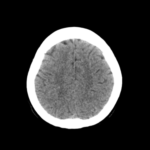 File:Bilateral PCA territory infarction - different ages (Radiopaedia 46200-50591 Axial non-contrast 18).jpg